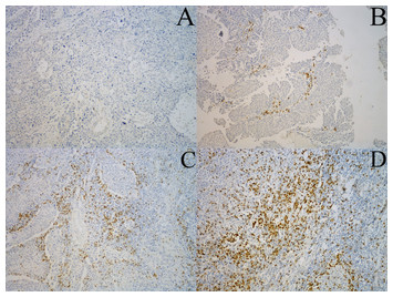 Tumor-infiltrating CD8+ lymphocytes predict different clinical outcomes ...