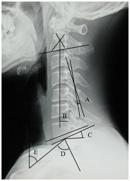 Preoperative radiographic measurement.