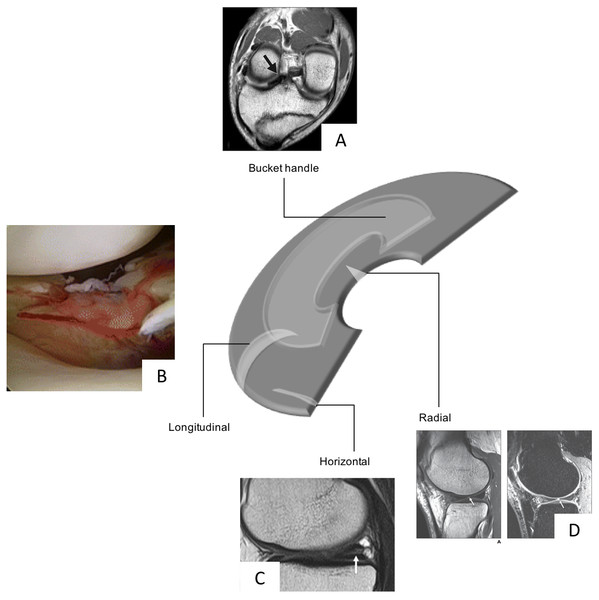 Schematic diagram highlighting the various types of meniscal tears, Bucket Handle MRI image taken from Han et al. (2015) (CC BY NC 3.0), Radial Tear, MRI image taken from Jung et al. (2012), and longitudinal (photograph taken from Feucht et al. (2015) (CC BY 4.0)) and horizontal tears (MRI taken from Ohishi et al. (2010) (CC BY 2.0)) all with permission.