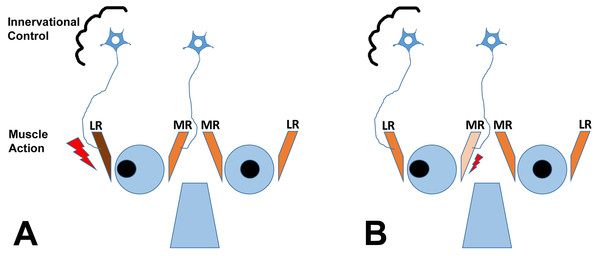 The cartoon depicts two scenarios (A and B) for a patient with exotropia, indicating muscle action of the agonist/antagonist horizontal eye muscles: the medial (MR) and lateral (LR) rectus muscles.