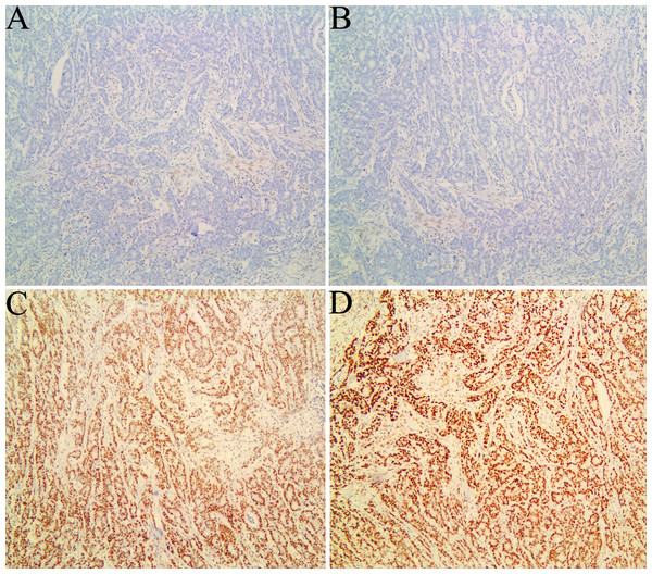 Immunohistochemical staining for mismatch repair proteins in one case of colorectal carcinoma.