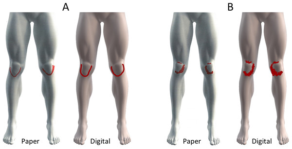 Pain drawings associated with the smallest (0.05%, A) and largest (1.1%, B) differences in pixel density between paper and digitally acquired pain drawings.
