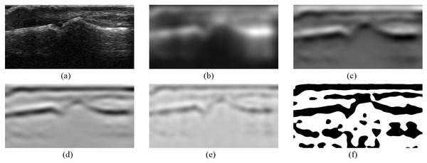 Images obtained from selected ITK filters: (A) the original image, (B) Gaussian smoothing, (C) smoothing first derivative, (D) smoothing second derivative, (E) Laplacian, (F) Laplacian positive threshold.