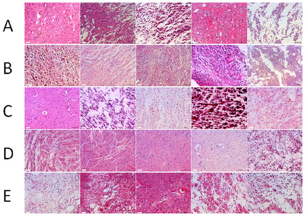 Morphology of glioma tissues preserved in liquid nitrogen of different storage periods (from 2011 to 2015).