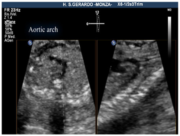 Aortic arch view, using live xPlane imaging.
