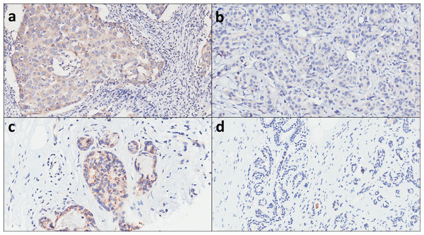 GADD45A expression levels are elevated in human breast cancer samples compared to adjacent non-neoplastic tissues.