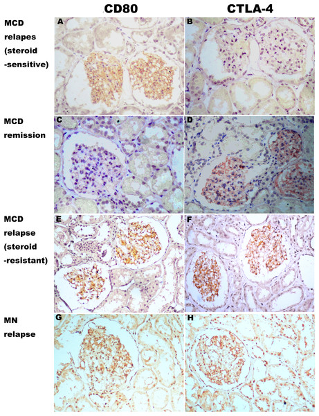 Expression of CD80 and CTLA-4 in glomerulus of several types of idiopathic nephrotic syndrome.