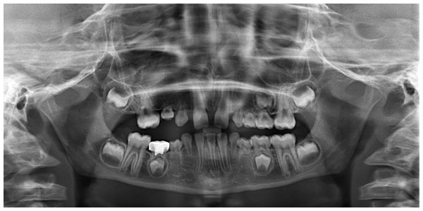 Panoramic radiograph of a subject affected by OI type III with missing teeth and DI.