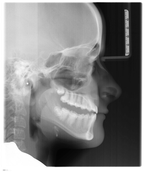 Lateral open bite on a subject affected by OI type IV treated with the Invisalign appliance.