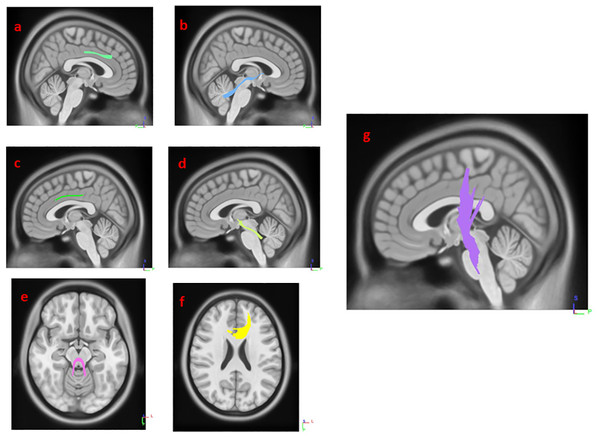 White matter pathways with significantly negative association with SCOPA-AUT in HY2PD patients (FDR = 0.0355872).