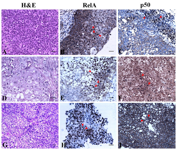 NF-κB heterodimer expression: High grade urothelial carcinoma.