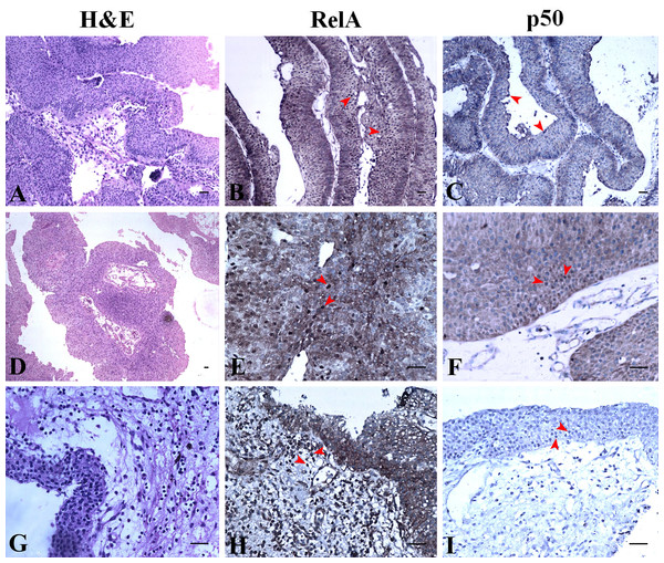 NF-κB heterodimer expression: low grade urothelial carcinoma with normal urothelium.