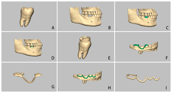 Computer-aided autotransplantation of tooth and virtual design of a series of novel surgical guides.