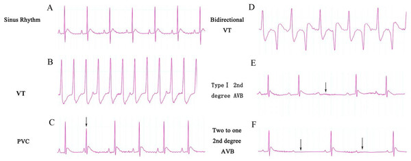 ECG categories that appeared in this experiment.
