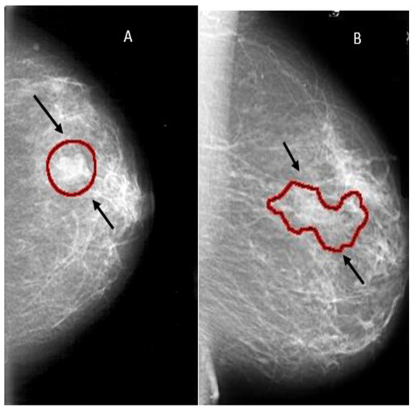 Examples of mammograms: (A) Mass ; (B) MCs.