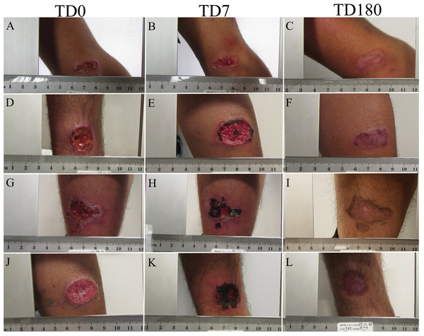 Evolution of ulcer in patients.