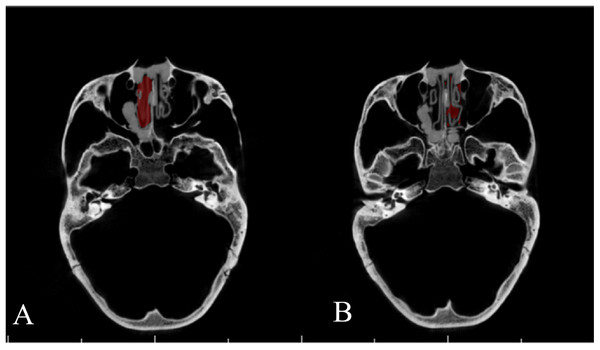 Segmentation of nasal airway space by INVIVO 5.