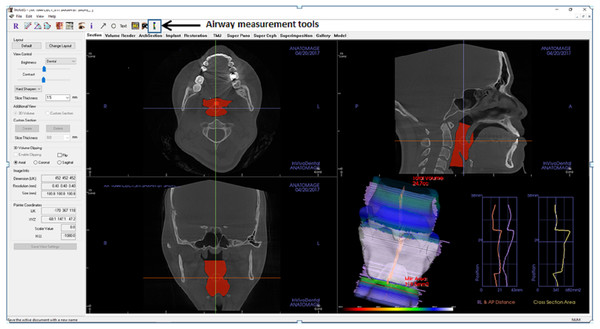 Display of Invivo5 software for airway analysis in ‘section’ menu.