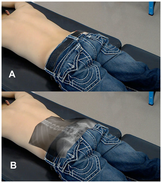 Examiner view of the participant (A) without OST-HMD and (B) with OST-HMD display displaying radiograph superimposed on a participant.