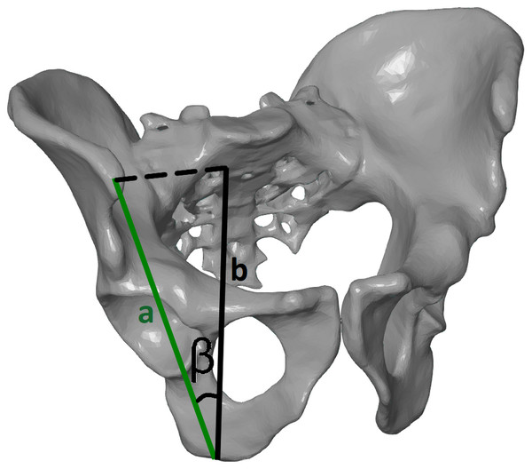 Tilt angle (ITA), measured in the frontal plane of the pelvis.