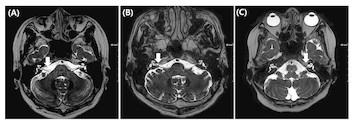 Anatomical location of AICA loop in CPA as a prognostic factor for ...