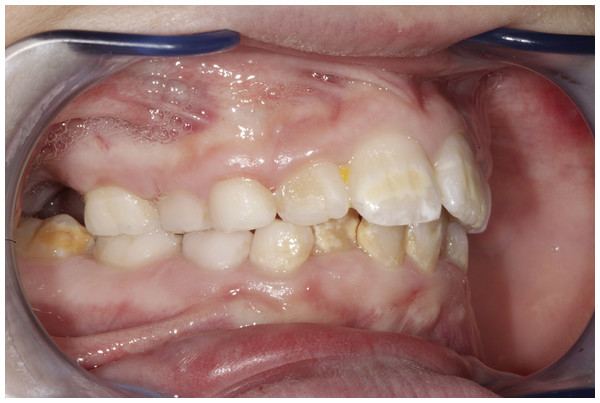 Periodontal condition in a growing subject with Marfan Syndrome.