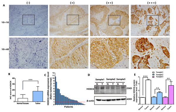 HOXC6 was highly expressed in ESCC tumor tissues.