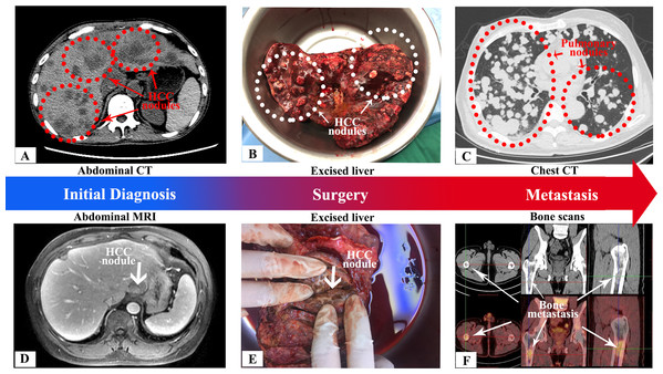 Preoperative CT and MRI scans, intraoperative tumor images and evidence of postoperative metastasis for two patients with tumor metastases.