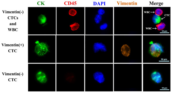 Fluorescence images of CTCs and WBCs.