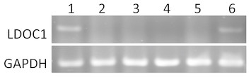 Salivary LDOC1 is a gender-difference biomarker of oral squamous cell ...