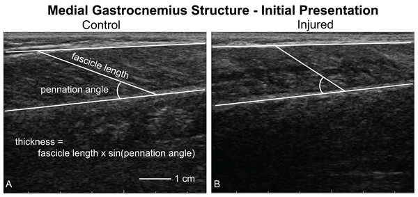 Ultrasound imaging quantifying muscle structure.