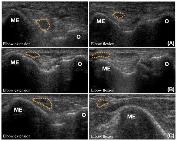 Retrospective study on the impact of ulnar nerve dislocation on the ...