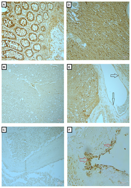 Expression of OPN in BAVM tissues.