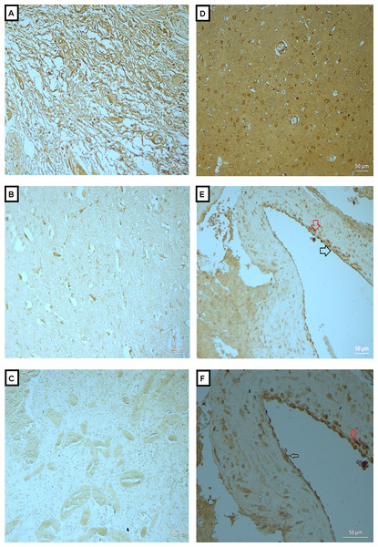 Expression of MMP-2 in BAVM tissues.