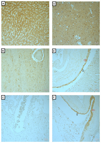 Expression of MMP-9 in BAVM tissues.