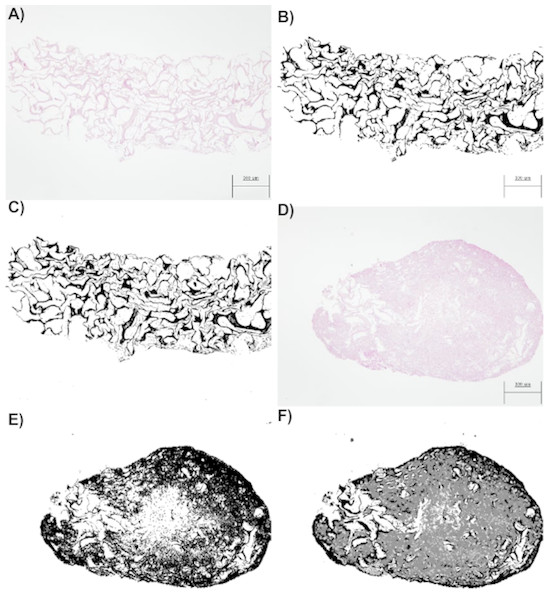 (A) An image obtained by optical microscopy and belonging to the CCO group (the osteogenic medium with cells). It was obtained at time = 18 days, that is, it corresponds to an early stage, where collagen is mostly found. (B) An image of collagen resulting from the application of segmentation based on the classical threshold (Threshold) to the image of (A). The area of collagen obtained with this technique is 178965 (189 pixels represent the 300 micrometers seen in the image). (C) An image of collagen resulting from the application of segmentation based on random forest to the image of (A). The area of collagen obtained with this technique is 175261 (189 pixels represent the 300 micrometers seen in the image). (D) An image obtained by optical microscopy and belonging to the CCO group (the osteogenic medium with cells). It was obtained at time = 38 days, that is, it corresponds to a stage where a large quantity of extracellular mass and nuclei is found, in addition to a lesser quantity of collagen. (E) A collagen image resulting from the application of segmentation based on the classical threshold (Threshold) to the image of (D). The area of collagen obtained with this technique is 384170 (189 pixels represent the 300 micrometers seen in the image). (F) A collagen image resulting from the application of segmentation based on random forest to the image of (A). The area of collagen obtained with this technique is 193125 (189 pixels represent the 300 micrometers seen in the image).