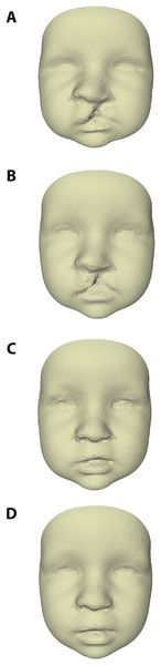Average faces of UCLP subjects at age (A) 3, (B) 6, (C) 9, and (D) 12 months of age.