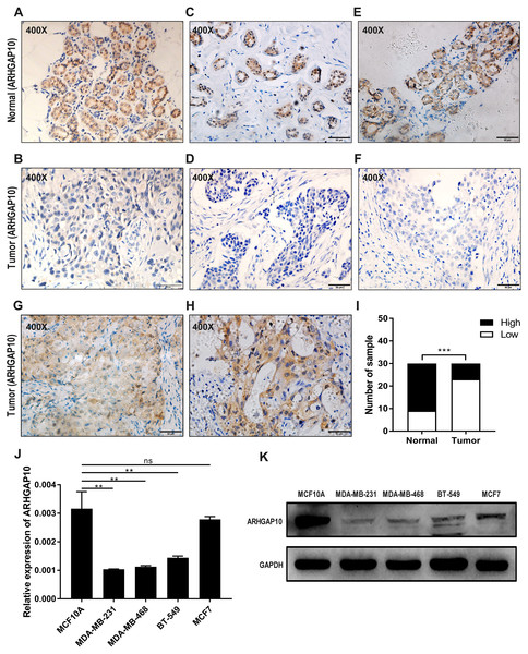 Reduced protein expression of ARHGAP10 in breast cancer tissues and expression pattern of ARHGAP10 in breast cell lines.