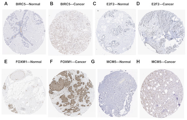 Validation of the potential target genes of miR-10b-5p in breast cancer from the HPA database.