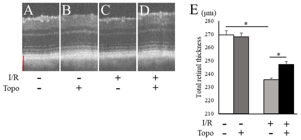 Evaluation of totalretinal thickness with OCT.
