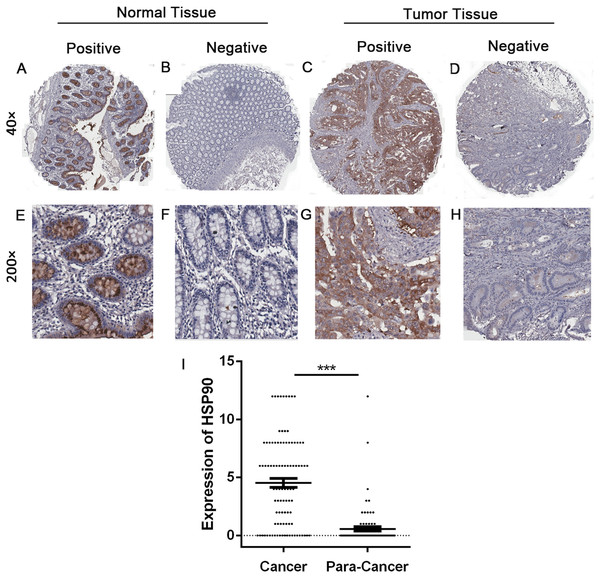 Immunohistochemistry and statistical results of HSP90 expression.