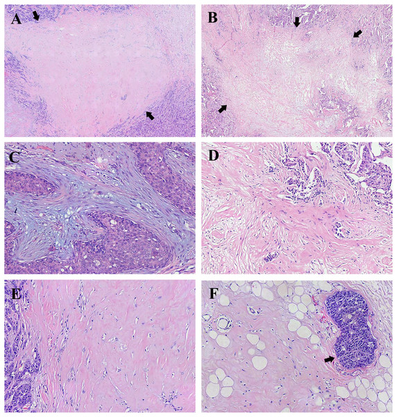 Representative histology of fibrotic focus (FF) in breast invasive ductal carcinoma (IDC).
