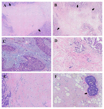 Association between the degree of fibrosis in fibrotic focus and the ...