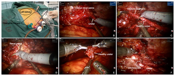 Robot-assisted laparoscopic redo pyeloplasty for a 59-year-old male who underwent a failed left pyeloplasty before.