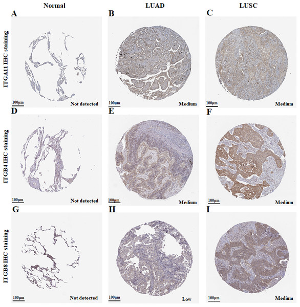 Immunohistochemistry analysis for ITGA11, ITGB4 and ITGB8 in NSCLC (HPA database).