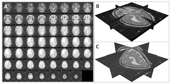 Volume reconstruction from DICOM images: (A) stack of 2D slices, (B) reconstructed 3D volume, and (C) resampled 3D volume.