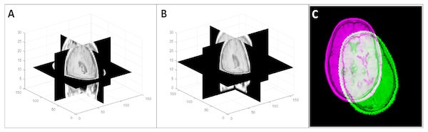 An example of a random 3D transformation: (A) original volume, (B) transformed volume (a rotation of +15 0 counterclockwise around the z axis and a translation of [3, 2, 2] in the x, y, and z direction respectively), and (C) mid-axial slices of both original and transformed volumes.