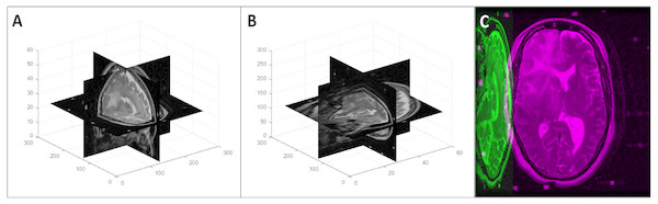 An example of a random 3D axis swapping: (A) original volume, (B) axis swapped volume with the x axis changed to the y axis and z axis changed to the x axis, and (C) mid-axial slices of both original and axis swapped volumes.