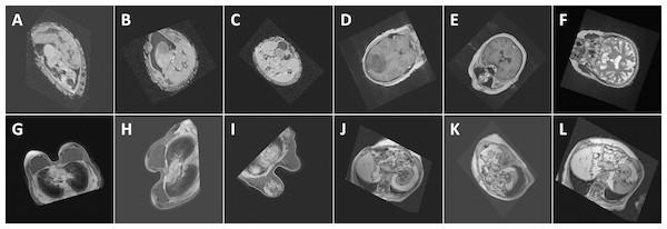 Performance (confidence level of classification) of the proposed method with respect to some random images: (A) Abdomen, 85.7%, (B) Abdomen, 92.3%, (C) Abdomen, 94.2%, (D) Head, 99.9%, (E) Head, 100%, (F) Head, 98.8%, (G) Breast, 100%, (H) Breast, 100%, (I) Breast, 100%, (J) Thorax, 98.9%, (K) Thorax, 98.9%, and (L) Thorax, 99.7%. The images show the views extracted using the proposed algorithm from 3D CT and MRI images in the test databases. Note that the differences in the images of the same class are caused by the simplicity of the segmentation method which influences the symmetry plane extraction.