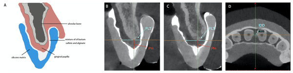 The sagittal axis of cone beam computed tomography imaging measurements of height and width of the interdental papilla.